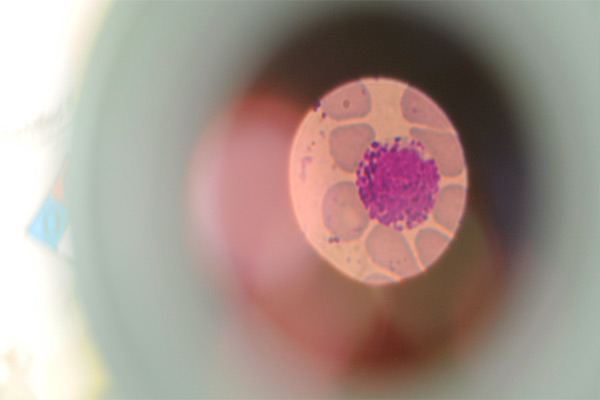 Equipos de hematología e investigadores